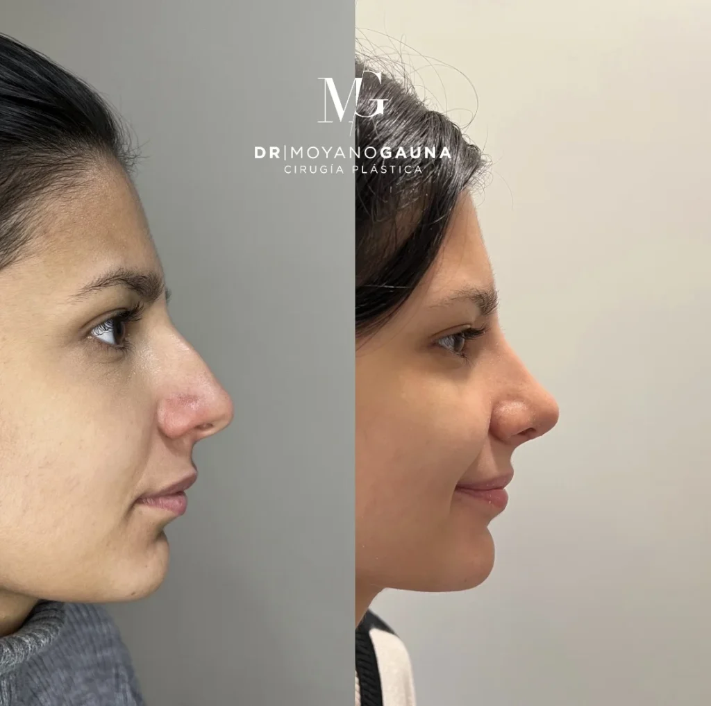 Rinoplastia