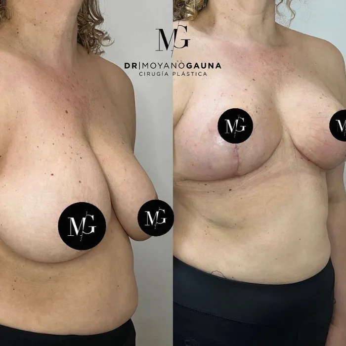 mastopexia sin implantes