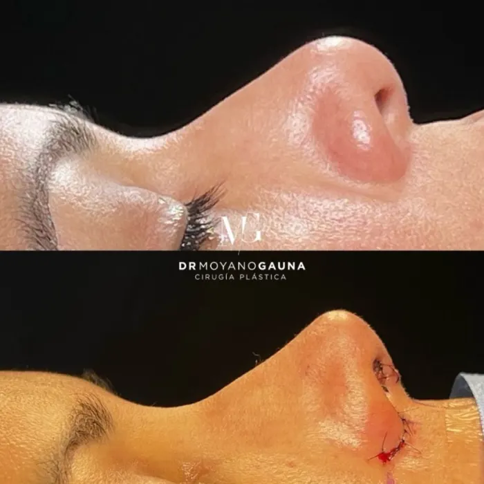 Diferencias entre Rinoplastia y Septoplastia