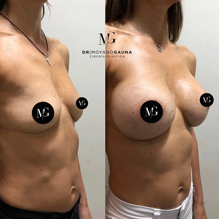 protesis mamarias en chile, guía completa 2026