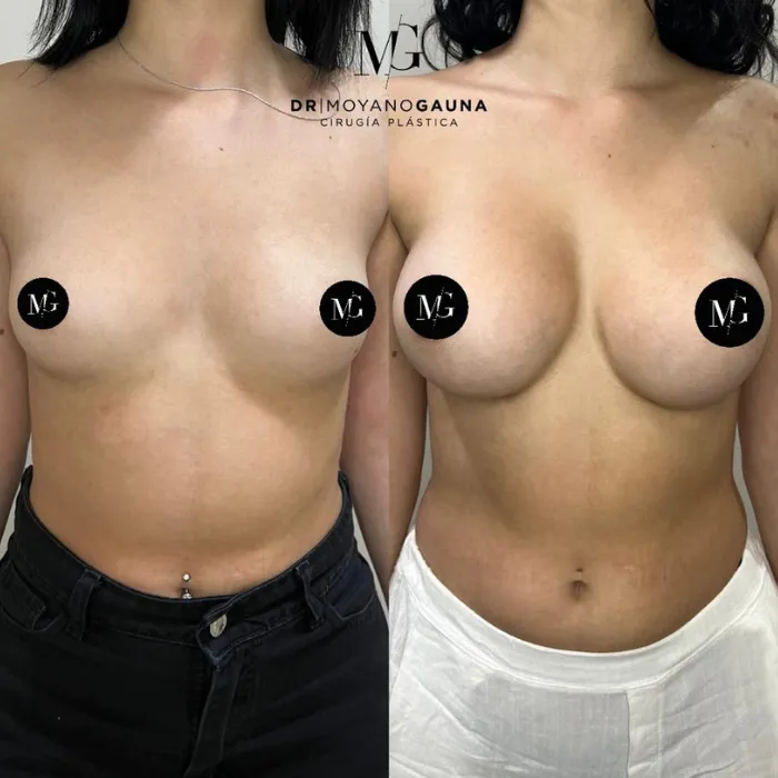 Implantes mamarios y su textura