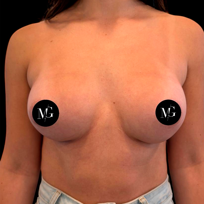 Protesis Mamarias según su forma