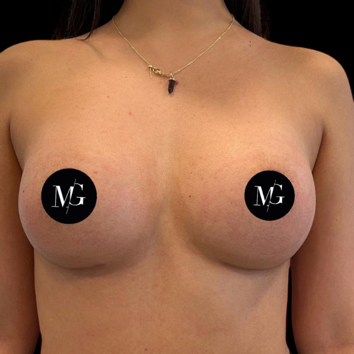 protesis mamarias segun su contenido