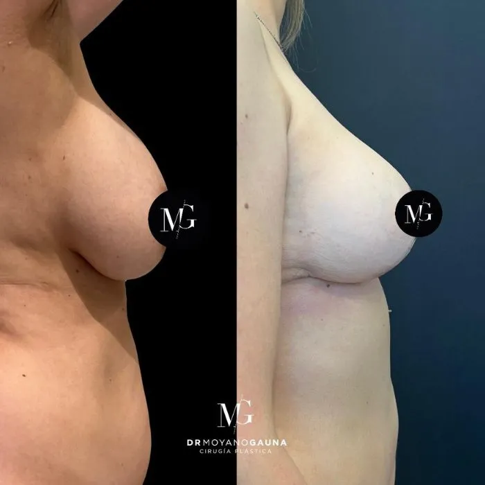 Cómo se realiza la mastopexia que es: técnicas y procedimiento quirúrgico