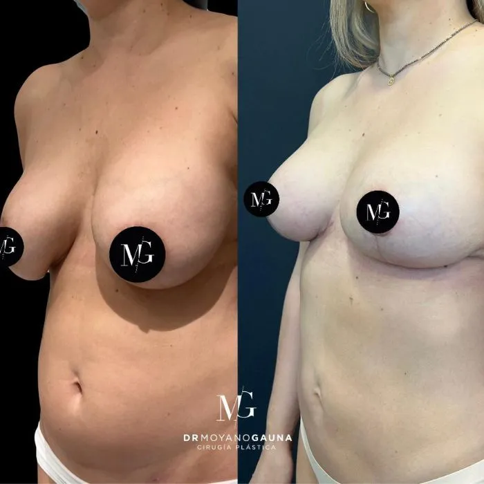 Mastopexia que es: Conoce que es y en que consiste este procedimiento