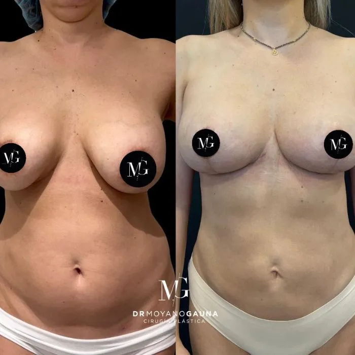 Beneficios y objetivos mastopexia