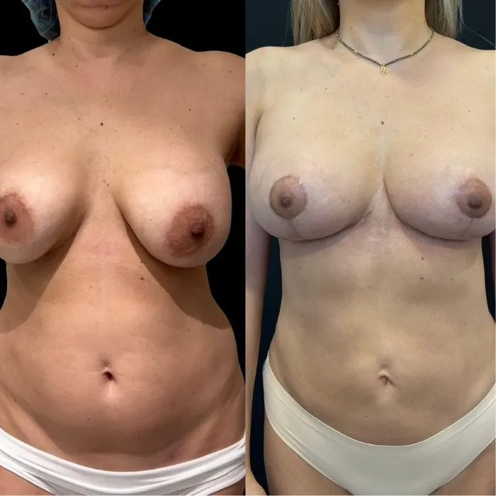 Recuperación postoperatoria y riesgos de la mastopexia