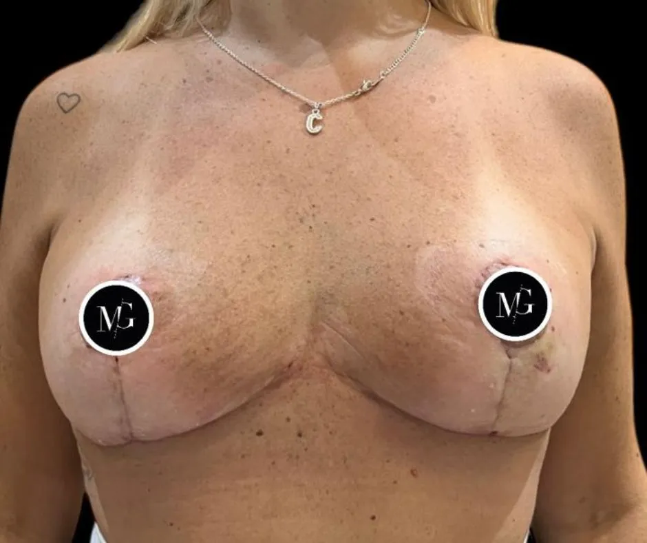 Cicatriz tras una mastopexia 1er mes