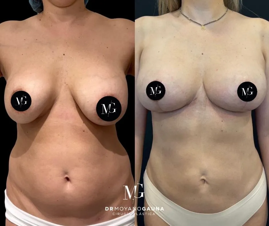 Cicatriz tras una mastopexia pasado el 6to mes