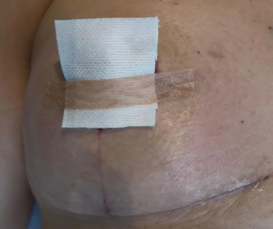 Cicatriz tras una mastopexia pasado el mes y medio