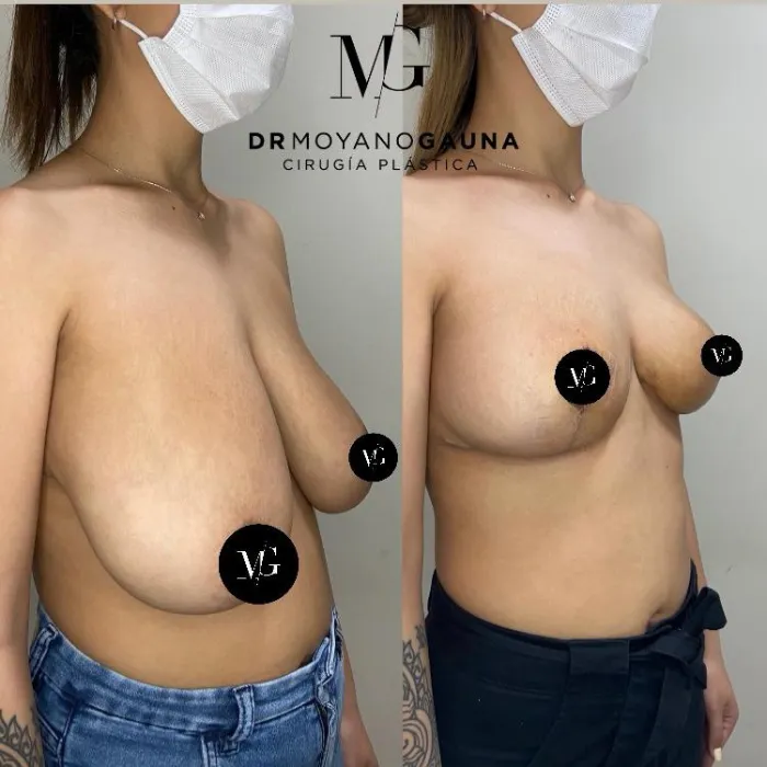 Reduccion Mamaria Chile