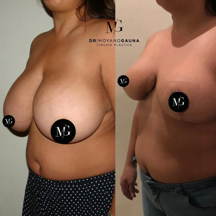 Reducción mamaria en Chile