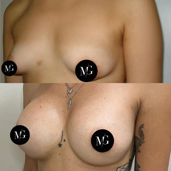 Mamas tuberosas y su impacto en el autoestima Portada