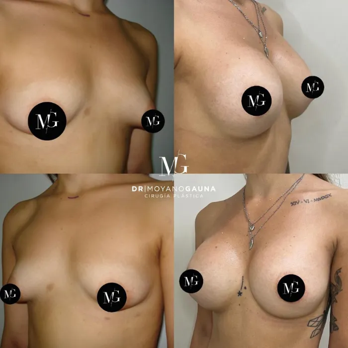 Mamas tuberosas y su impacto en el autoestima