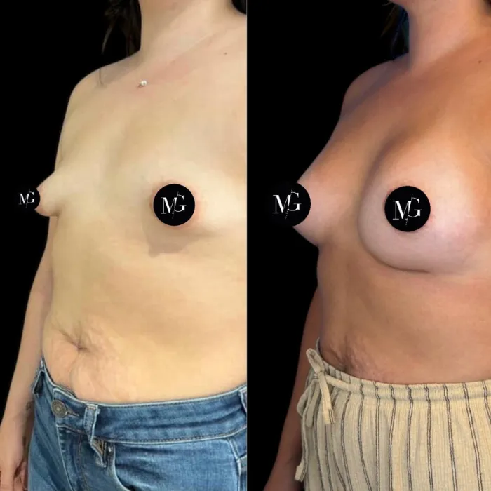 Que son las mamas tuberosas Caso 1