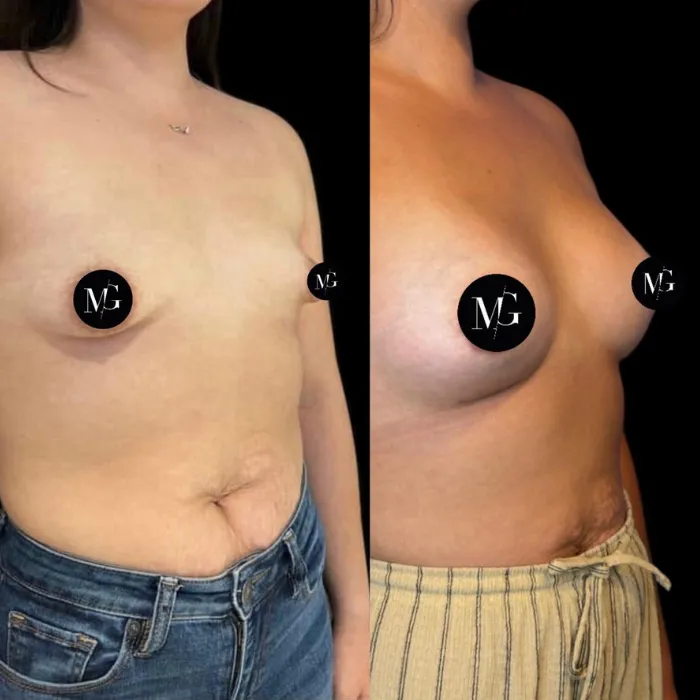 Que son las mamas tuberosas Caso 2