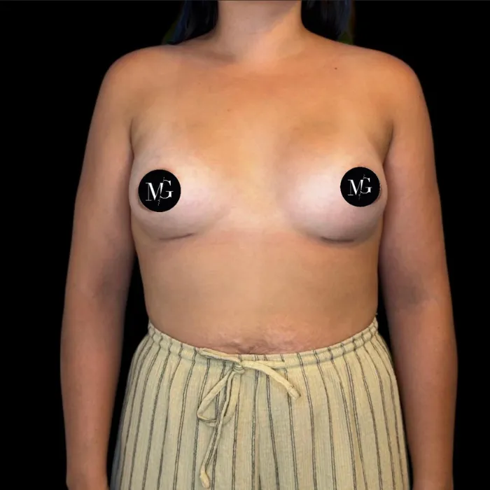 Que son las mamas tuberosas Caso 3